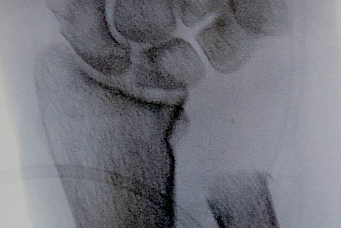 DRUJ post Distal Ulna Resection