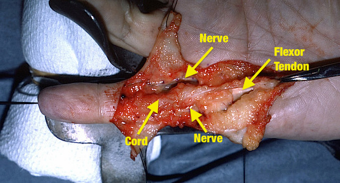 Central cord with both digital nerves exposed and flexor tendon visible proximally.