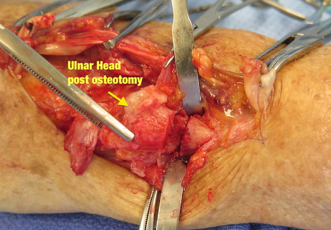 Distal ulna has been removed by an osteotomy at the ulnar neck (Darrach procedure)