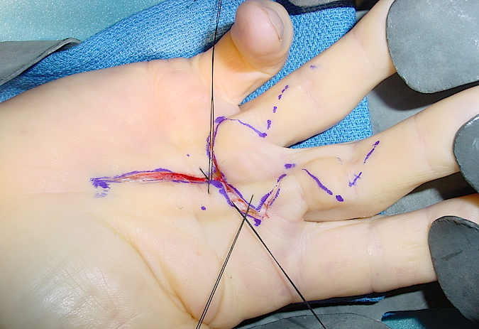 Zig-Zag incisions with distal web flap with retention sutures in place