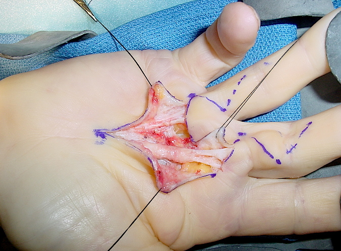 Central cords to long and ring fingers exposed