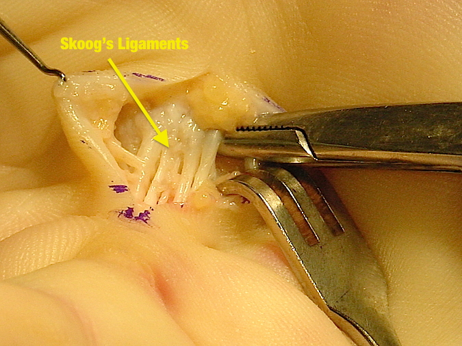 Close up view of Skoog's ligaments (superficial intermetacarpal ligaments)