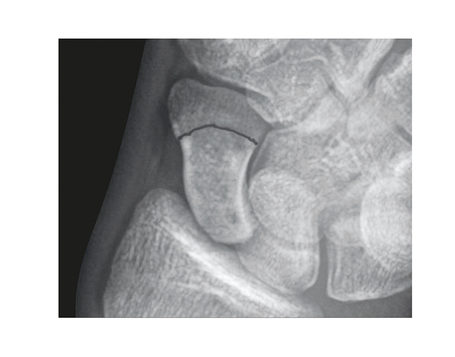 Scaphoid (Navicular) Fracture Distal 1/3;Mid 1/3 Non-displaced