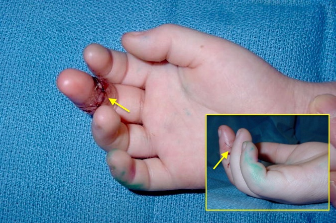 Right long finger FDP laceration at the DIP joint level (arrow) with lack of DIP flexion (insert).