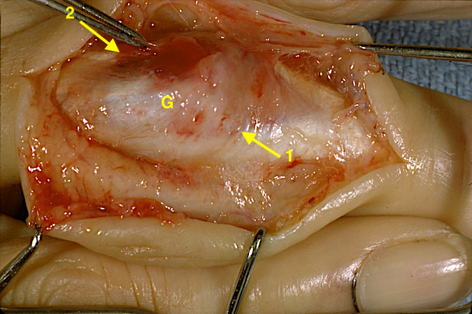 Neglected Complex PIP dislocation with 1 - edge of the central extensor tendon; 2 - lateral band heading into the PIP joint; G - granulation tissue over ruptured collateral ligament and in split between lateral band and central extensor.