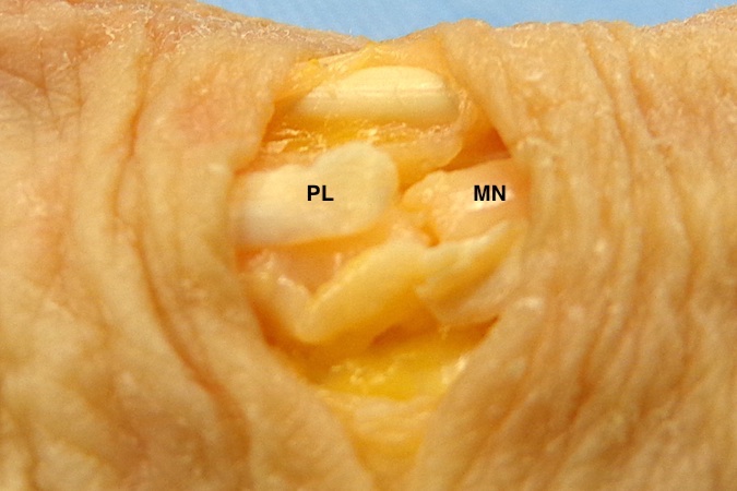 Median Nerve (MN) Laceration with cut palmaris longs (PL).