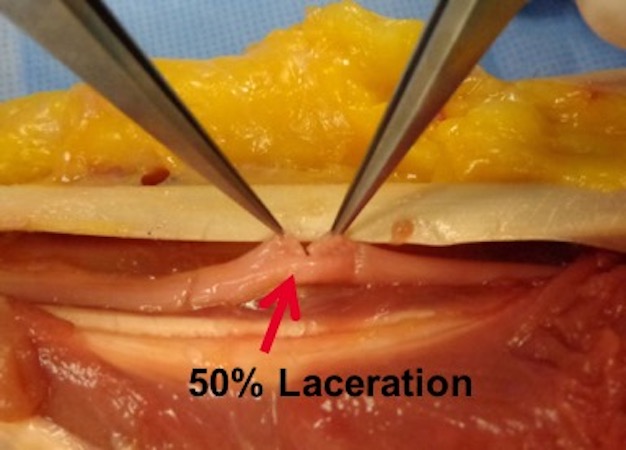 Median nerve in distal third of forearm with a 50% partial laceration from a glass cut.