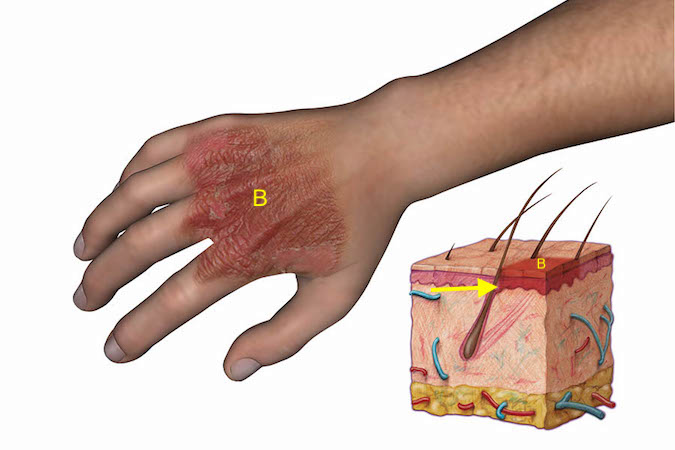 First degree burn of the dorsum of the hand. Note burn area (B) and depth (arrow). Note this superficial burn is devoid of blisters, has associated erythema and significant pain because of intact nerve endings.