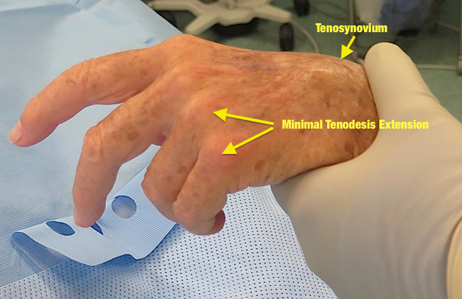 No Tendodesis Effect demonstrated in 4th & 5th fingers with wrist in palmar flexion
