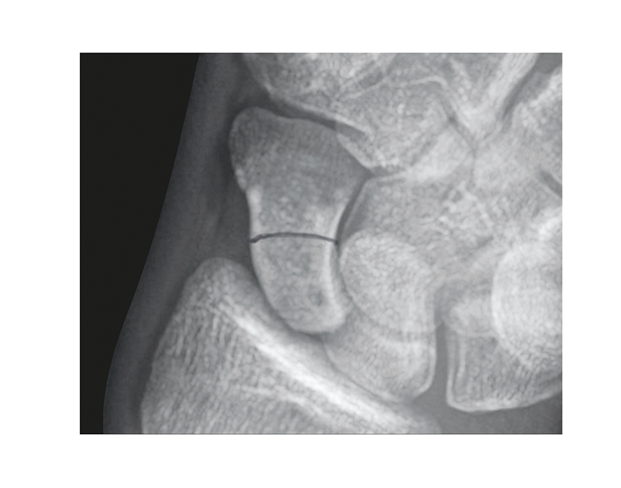 Scaphoid (Navicular) Fracture Middle 1/3 Non-displaced