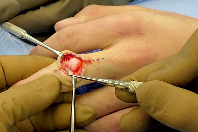 Excision of painful enlarging knuckle pad