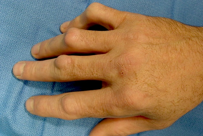 Knuckle pads caused by Dupuytren's Disease which sometimes appear before palmar cords or nodules.