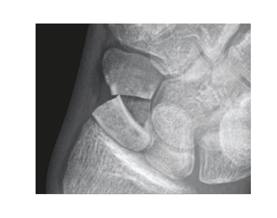 Scaphoid (Navicular) Fracture Middle 1/3 Displaced.  This fracture will be at risk for AVN, post-traumatic arthritis and need ORIF.