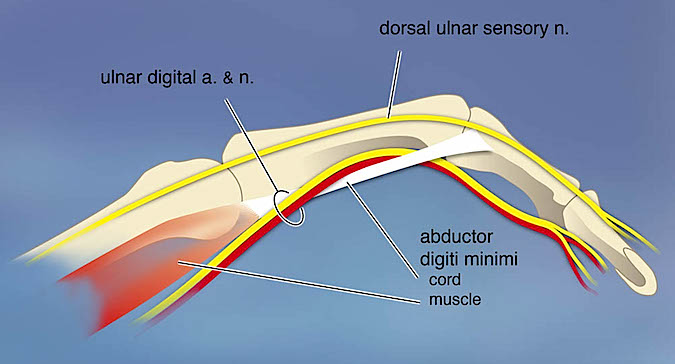 Abductor digiti minimi cord with ulnar digital nerve and dorsal sensory nerve.
