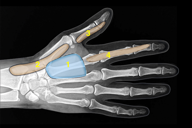 Note the thenar space and its relationship to the radial bursa and flexor sheaths of the thumb and index finger.