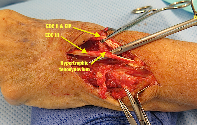Intact tendons with excess tenosynovium