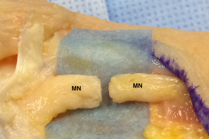 Median Nerve (MN) Laceration ready for repair with minimal gap.