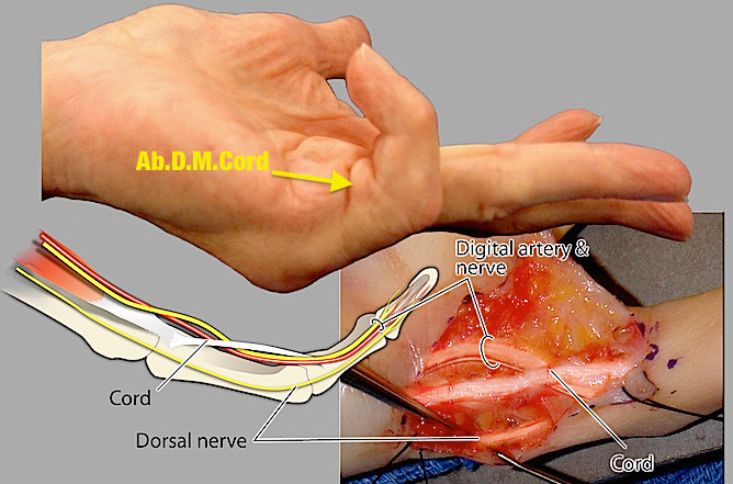 Abductor Digiti Minimi Cord and ulnar digital nerve and dorsal ulnar sensory nerve,
