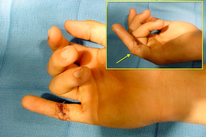 Right little finger FDP laceration with probable intact or partially intact FDS (arrow).