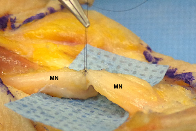 Median Nerve (MN) Laceration begun.  One 8-0 nylon suture in place which easily controls the tension between the nerve endings.