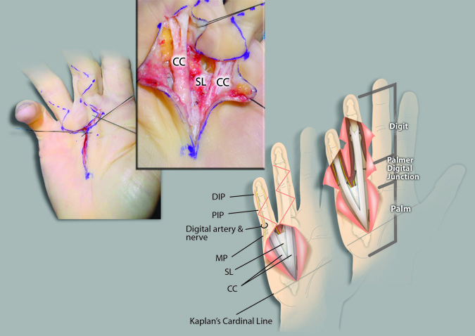 Central cords exposed with zig-zag incisions in two adjacent affect fingers.
