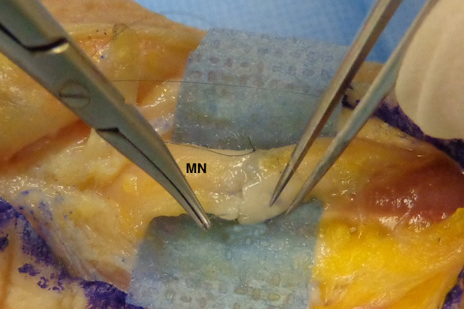 Median Nerve (MN) Laceration.  Second suture being placed.