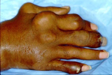 Severe uncontrolled chronic tophaceous gout