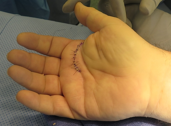 Transverse incision used to release index and long trigger fingers closed with simple sutures.