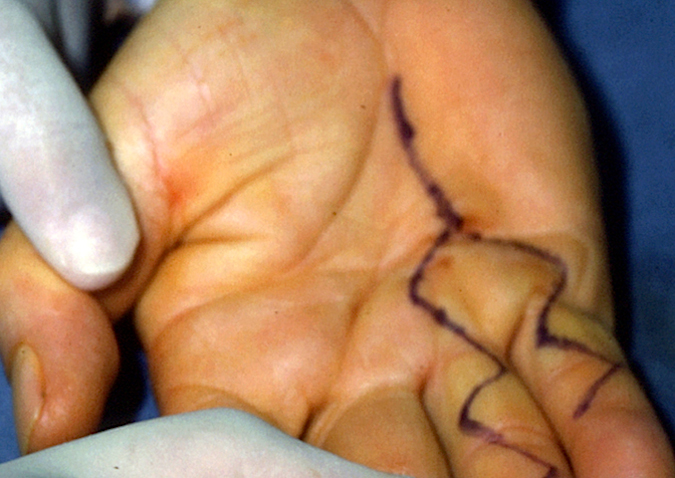 Standard double zig-Zag incisions with a distally based web flap.