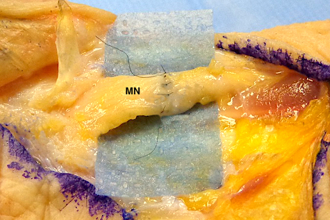 Median Nerve (MN) Laceration. Palmar median nerve micro-repair completed.