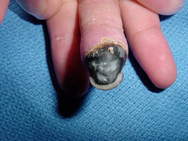 Fingertip necrosis associated with Buerger disease