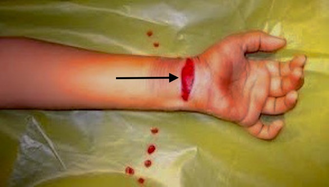 Typical volar wrist laceration associated with a median nerve laceration.