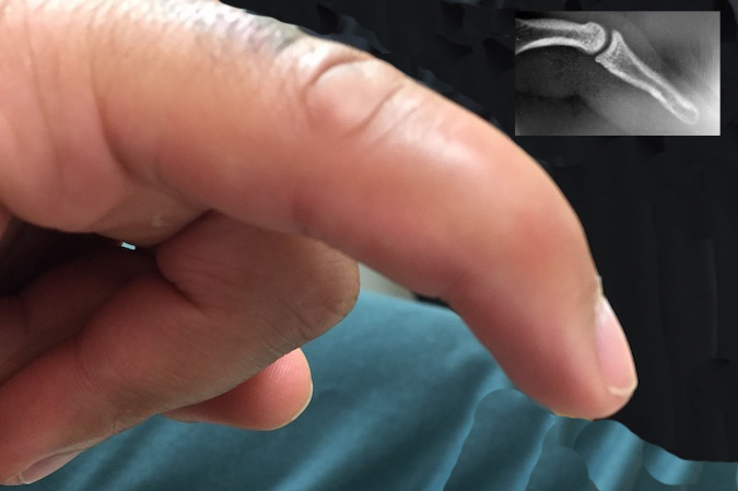 Acute mallet Finger Left Fifth - Note extension lag, swelling and X-ray negative for fracture.