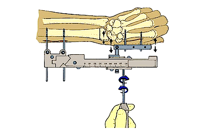Wrist jack with pins in radius and index metacarpal bone