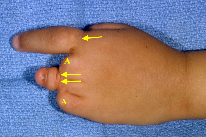 Dorsum of the left hand with severe congenital constriction bands: mild constriction band (1); proximal digit amputation secondary to amniotic bands (2); severely hypoplastic digit with nail deformity from amniotic band (3); secondary partial incomplete syndactyly secondary to congenital constriction (amniotic) bands (4)
