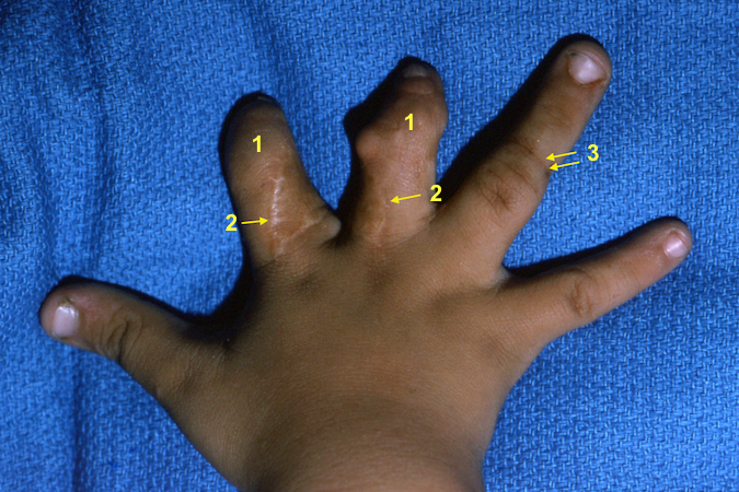 Dorsum of the right hand with severe congenital constriction bands after earlier surgical treatment: hypoplastic index and long fingers (1);  surgical scars from prior z-plasties (2); moderately severe constriction band (3)