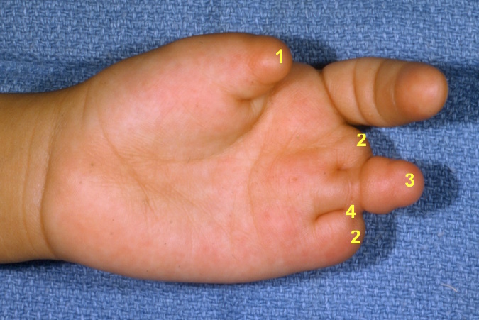 Palm of the left hand with severe congenital constriction bands: thumb tip amputation secondary to constriction band (1); proximal digit amputation secondary to amniotic bands (2); severely hypoplastic digit also caused by amniotic band (3); secondary partial incomplete syndactyly secondary to congenital constriction (amniotic) bands (4)