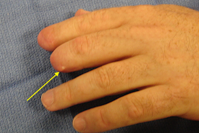 Long finger amputation complicated by a painful inclusion cyst (arrow).
