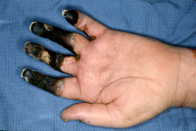 Necrotic fingers secondary to severe peripheral vascular prior to amputations .