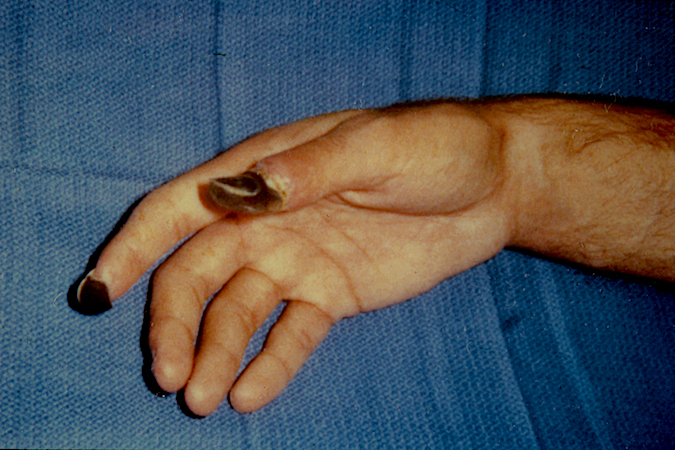 Necrotic index and thumb tip after hypovolemic shock and a thromboses radial artery.