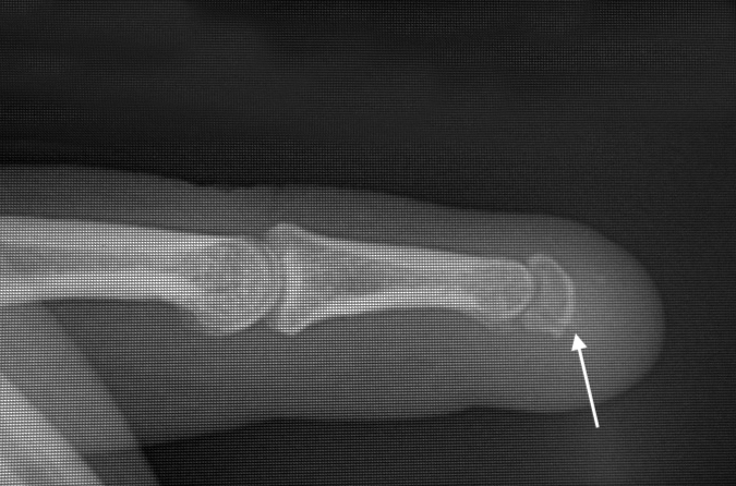 Amputation through distal phalanx at the base of the nail.  Tip has a  bulbous appearance but FDP tendon intact.