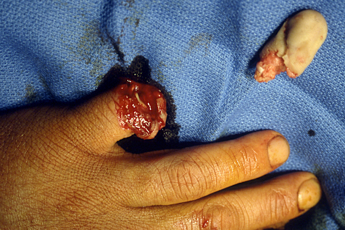 Left little finger crush avulsion amputation not suitable for replantation.