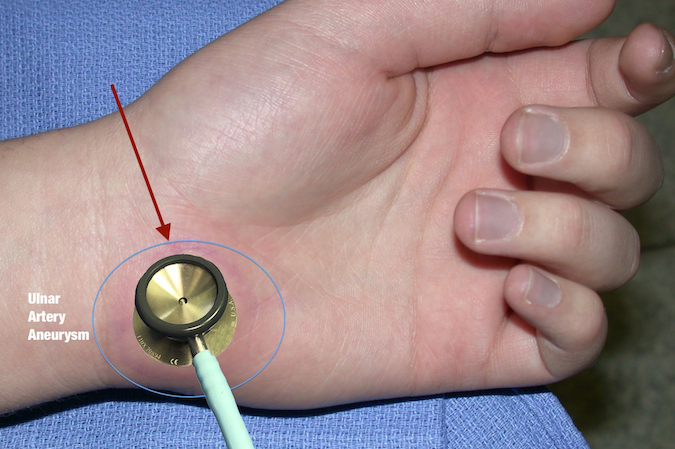 Stethoscope auscultating ulnar artery aneurysm (arrow) for a bruit