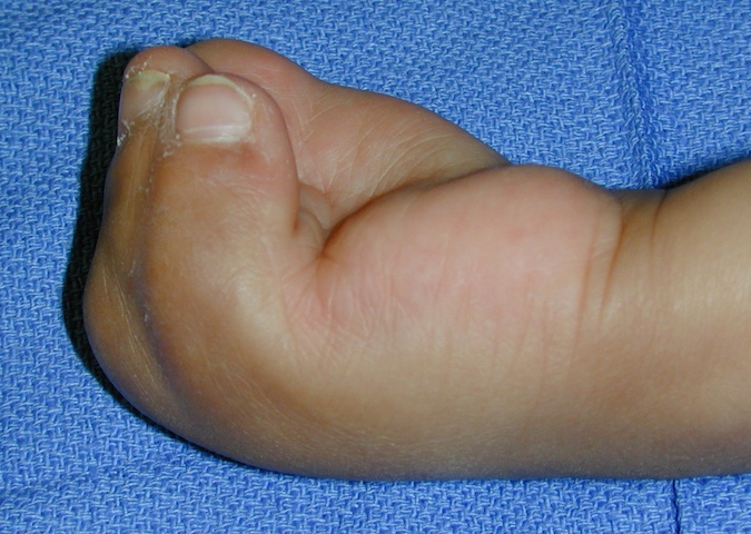 Apert's Syndactyly