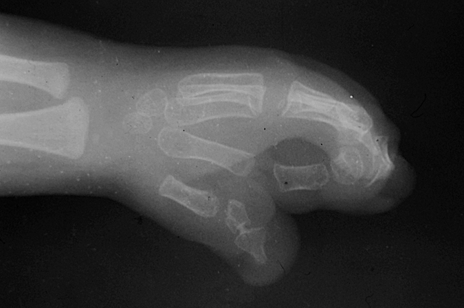 X-ray of  complex Apert's syndactyly