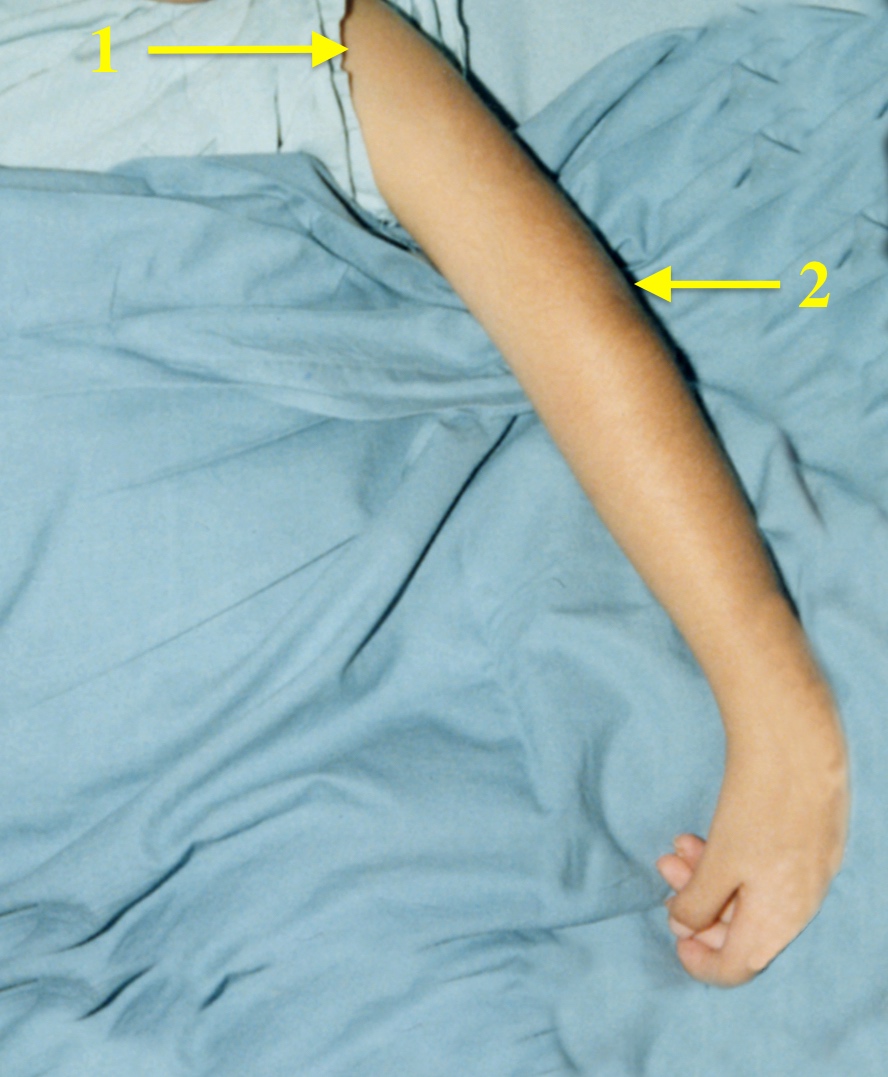 Arthrogryposis Shoulder and Elbow: 1.Shoulder internally rotated; 2. Elbow with an extension contracture