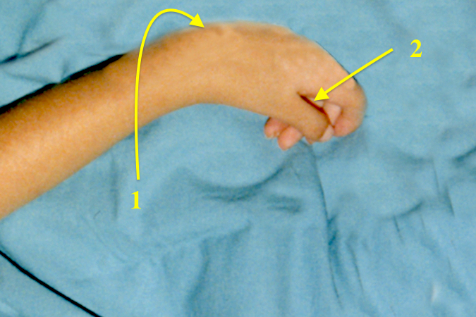 Arthrogryposis wrist and Hand: 1. Wrist in classic palmar flexion and ulnar devotion position; 2. Hand with thumb-in-palm deformity and mild wind blown fingers.