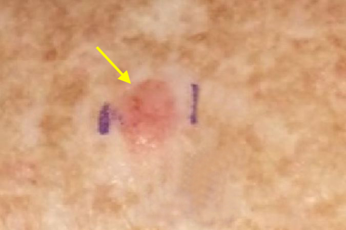 Basal cell carcinoma on the dorsum of the left hand.