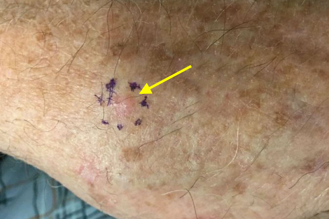 Small basal cell carcinoma on the dorsal ulnar aspect of the right hand.