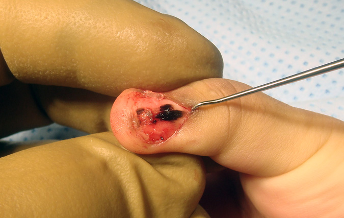 Blue Nevus Thumb Nail - melanotic changes in sterile matrix